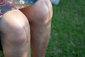 paciente asiática anciana muestra sus cicatrices reemplazo total quirúrgico de la articulación de la rodilla. foto