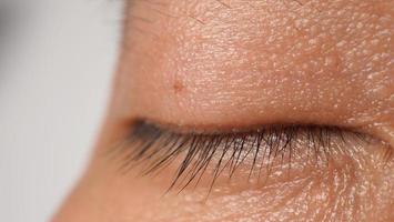 Wart on face. Macro shot of wart near eye. Papilloma on skin. photo