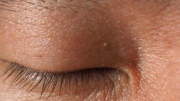 Wart on face. Macro shot of wart near eye. Papilloma on skin. photo