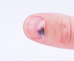 Subungual hematoma under nail photo