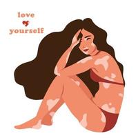 Girl in a swimsuit with vitiligo. Girl with long hair. World vitiligo day. The concept of self-acceptance, self-love. Vector illustration