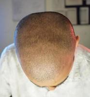 a head image after baldness photo