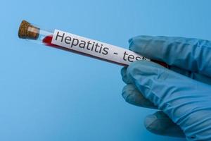 Hepatitis test, Blood in the test Tube. photo