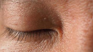 Wart on face. Macro shot of wart near eye. Papilloma on skin. photo