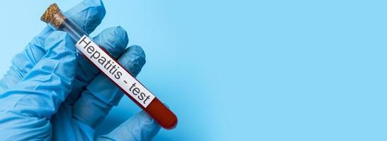 Hepatitis test, Blood in the test Tube. Place under the text. photo