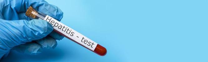 Hepatitis test, Blood in the test Tube. Copy space. photo