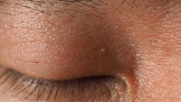 Wart on face. Macro shot of wart near eye. Papilloma on skin. photo