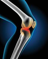 The picture shows an injury to the knee joint. vector
