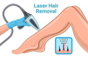 Laser Hair Removal Woman Legs