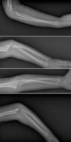 Broken arm xray photo