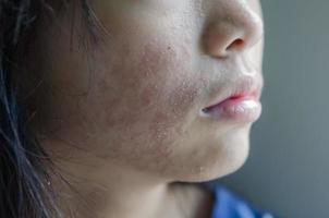 erupción facial mujer alérgica a los cosméticos alergia alimentaria o alergia al aire foto