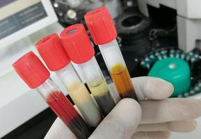 Scientist hand hold Common types of blood serum sample errors. Different types of sample which interfere test result. photo