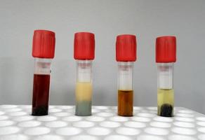 Common types of blood serum sample errors. Different types of sample which interfere test result. photo