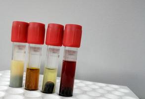 Common types of blood serum sample errors. Different types of sample which interfere test result. photo