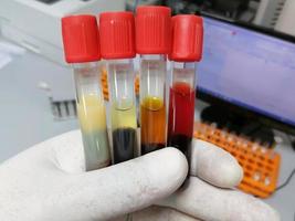 Scientist hand hold Common types of blood serum sample errors. Different types of sample which interfere test result. photo