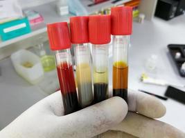 Scientist hand hold Common types of blood serum sample errors. Different types of sample which interfere test result. photo