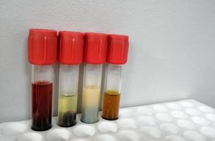 Common types of blood serum sample errors. Different types of sample which interfere test result. photo