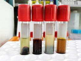 Common types of blood serum sample errors. Different types of sample which interfere test result. photo