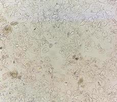 Photomicrographic close view of Abnormal urine analysis with copy space. Epithelial cell, Pus cell. photo