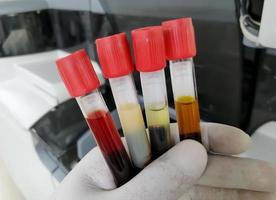 Scientist hand hold Common types of blood serum sample errors. Different types of sample which interfere test result. photo