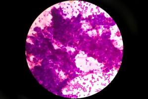 microfotografía de carcinoma mucoepidermoide de glándula parótida foto