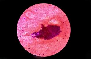 Metastatic adenocarcinoma of lung. Pleural fluid cytology of lung papillary adenocarcinoma, a type of non small cell carcinoma photo