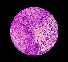 Photomicrograph of an sinonasal inverted papilloma a benign tumor that may occur in the nasal cavity or paranasal sinuses, 40X photo