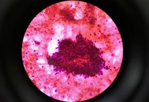 Metastatic adenocarcinoma of lung. Pleural fluid cytology of lung papillary adenocarcinoma, a type of non small cell carcinoma photo