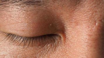 Wart on face. Macro shot of wart near eye. Papilloma on skin. photo