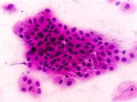 Pap's smear pap stain Microscopic 100x Zoom show High-grade squamous intraepithelial lesion is a pre-cancerous, sexually transmitted disease photo