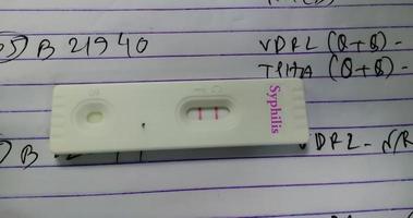 vista cercana del dispositivo de sífilis, la prueba de detección rápida muestra un resultado positivo de un paciente. prueba de detección rápida. vdrl. tfa. foto