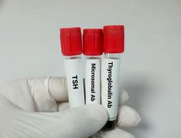 Blood sample in test tube for hormonal examination of thyroid gland in laboratory. Anti microsomal, anti thyroglobulin, TSH. Diagnosis of thyroid cancer photo