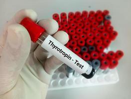 Blood sample in test tube for hormonal examination of thyroid gland in laboratory. Thyrotropin or TSH, diagnosis of hyperthyroidism or hypothyroidism of a patient photo