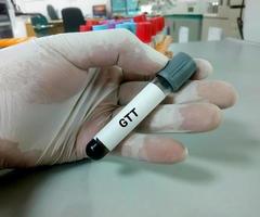 Technician or scientist hold a sample tube of Glucose Tolerance Test or GTT photo