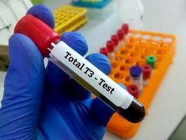 Blood sample in test tube for hormonal examination of thyroid gland in laboratory. Total T3 or Triiodothyronine test. Diagnosis of hyperthyroidism or hypothyroidism of a patient photo