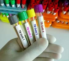 Close view of scientist hand hold blood samples for TB Gold or Quantiferon test. 4 samples for TB test. diagnosis for mycobacterium tuberculosis infection. photo