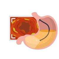 Gastroscopy. Endoscopy and digestive problems. Hose with camera vector