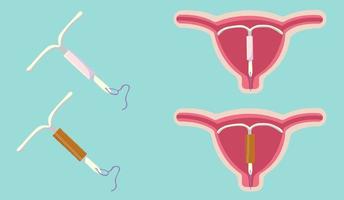 Ilustración de vector de dispositivo intrauterino