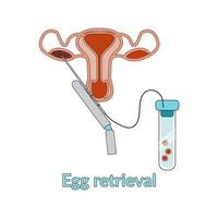 Vertor illustration for specialized manuals. Oocyte retrieval. Egg donation. Donor. Extracorporeal fertilization. Flat style vector. vector