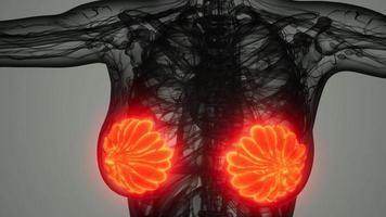 analyse médicale du cancer du sein chez la femme