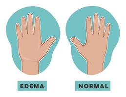 Swollen hand and normal hand. Edema and lymphedema. Vector illustration of the disease before-after.