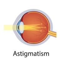 ilustración de astigmatismo y trastornos de la visión. concepto de defecto ocular. globo ocular de anatomía detallada con defecto de astigmatismo. vector aislado