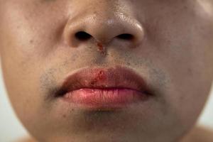 Cracked lips of man in winter season. Close up shot. This man skin is asian style. photo