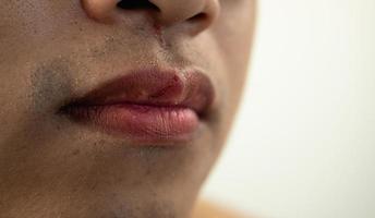 Cracked lips of man in winter season. Close up shot. This man skin is asian style. photo
