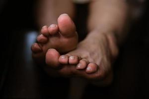 Woman' legs with uneven toe. Close-ups of both feet with selective focus, small photo