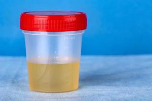 Plastic container with urine analysis photo