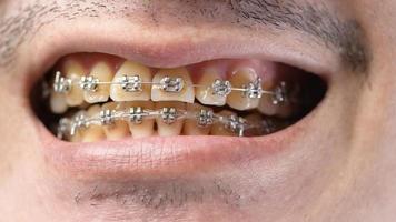 primer plano de la boca del hombre con aparatos ortopédicos, dientes de placa amarilla porque bebe café regularmente foto