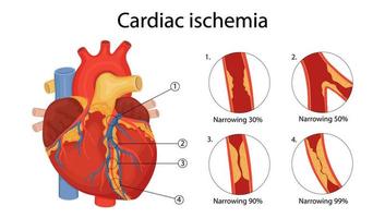 cardiac ischemia. anatomical illustration drawn in cartoon style vector