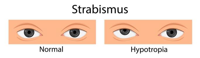 Types of strabismus. Hypotropia, hypertropia, esotropia. cartoon style vector