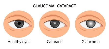 illustration of a healthy eye, glaucoma, cataract.